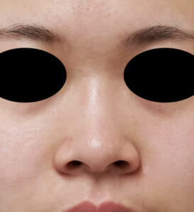 小鼻縮小(フラップ法)術前正面