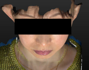 バッカルファット除去　上から　3ヶ月後