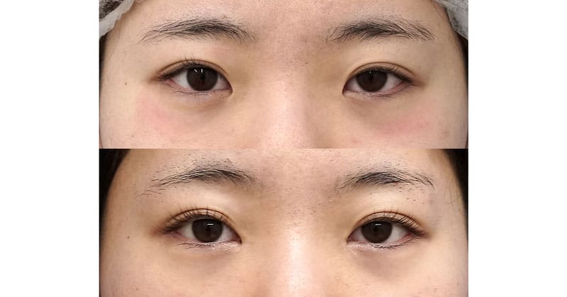 目を大きく華やかに｜目頭切開（Z形成）　６ヶ月後