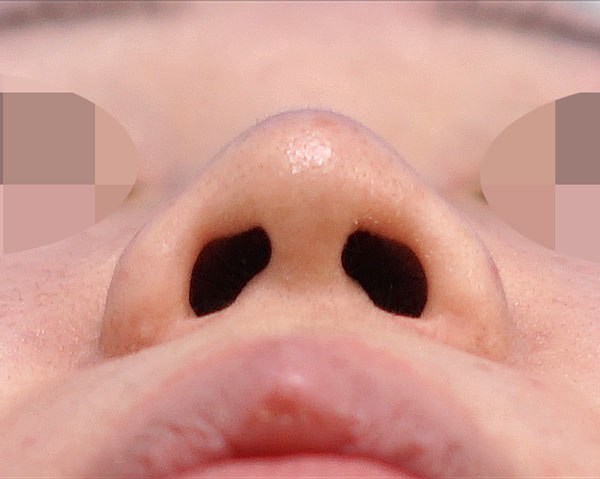 鼻尖形成・鼻中隔延長　下から　術前