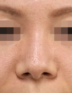 小鼻縮小(内側+外側)術前 正面