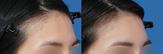 額の凹みが気になる方へ｜自然に整えるヒアルロン酸症例