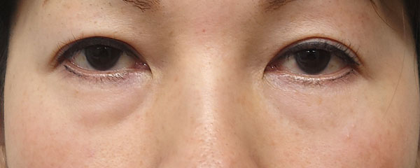 目の下くま取り（裏ハムラ）　３ヶ月後経過のBefore写真