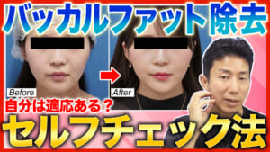 【小顔治療】バッカルファット除去を受けても大丈夫？適応のセルフチェック法も解説