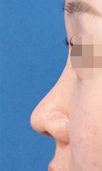 鼻尖形成・鼻中隔延長　左側面　３ヶ月後