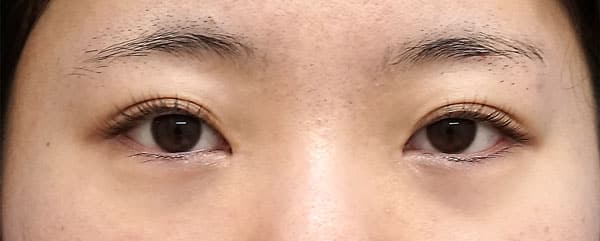 目頭切開（Z形成）　６ヶ月後のAfterの写真