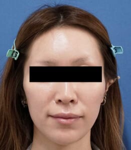 額ヒアルロン酸① 処置後