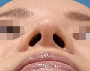 小鼻縮小(内側+外側)術後 下から