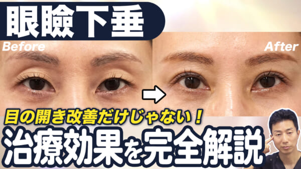 目が開きやすくなるだけじゃない！切る眼瞼下垂の効果とメリット・デメリットを解説　