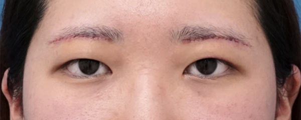 眉下切開　１週間後（抜糸直後）のAfterの写真