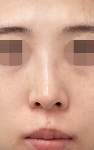 3か月後鼻正面