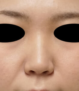 鼻ヒアルロン酸処置前