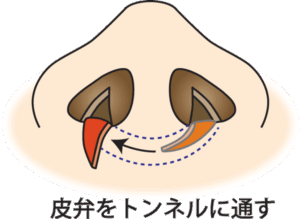 フラップ法トンネルに通す