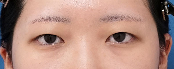 眉下切開（一重のまま目を大きく）　６か月後のAfterの写真