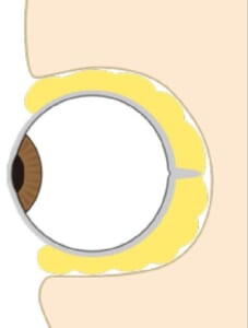 眼窩内の眼窩脂肪