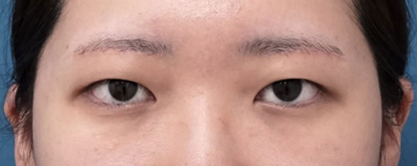 眉下切開　３ヶ月後のAfterの写真