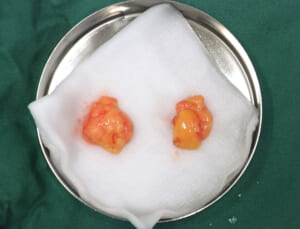 バッカルファット画像