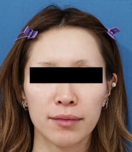 額ヒアルロン酸① 処置前