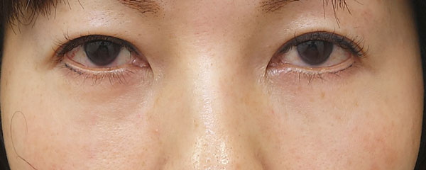 目の下くま取り（裏ハムラ）　１ヶ月後経過のAfterの写真