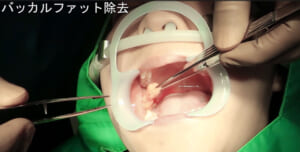 バッカルファット
