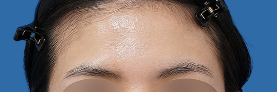 額ヒアルロン酸 術後1週間 正面のBefore写真