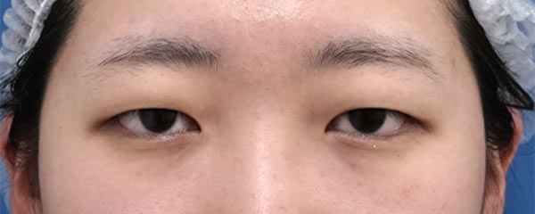 眉下切開　３ヶ月後のBefore写真