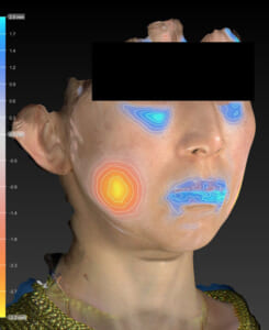 バッカルファット除去　右斜め　変化