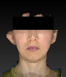 バッカルファット除去　正面　手術前