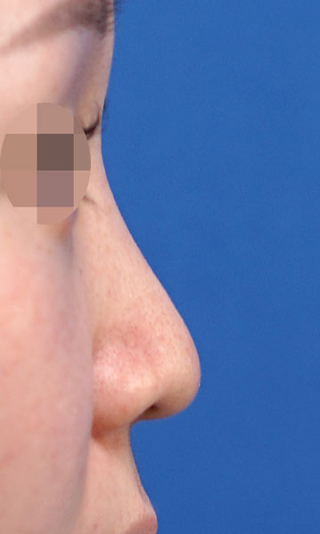 鼻尖形成・鼻中隔延長　右側面　術前