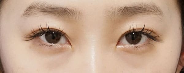 二重埋没法抜糸＋二重埋没法（3点連結止め）もとびアイゴールド　4か月後