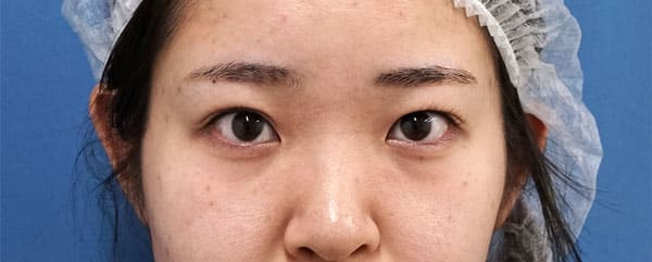 眉下切開　１ヶ月後のBefore写真