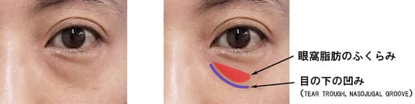 目の下の凹凸くまの位置の解説画像