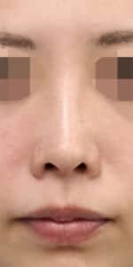 鼻尖縮小・軟骨移植・ストラット　術前　正面