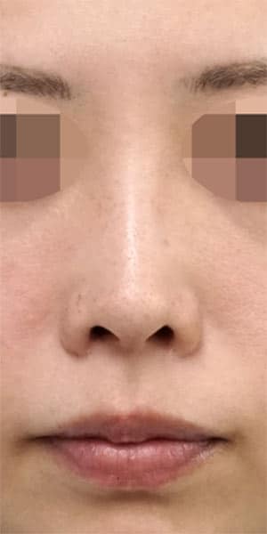 鼻尖縮小・軟骨移植・ストラット　６か月後　正面のBefore写真
