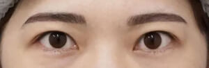 眉近い人術前