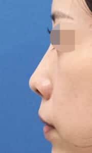 鼻尖縮小・軟骨移植・ストラット　術前　左側面