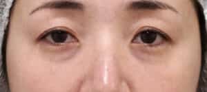 目の下くまとり手術（目の下脂肪取り＋コンデンス脂肪注入）　手術前