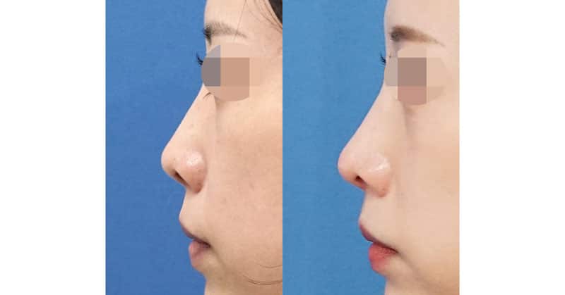 鼻先を斜め下方に。鼻先をシュッとさせる｜鼻尖縮小・軟骨移植・ストラット　６か月後