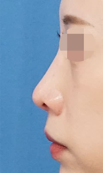 鼻尖縮小・軟骨移植・ストラット　６か月後　左側面のAfterの写真