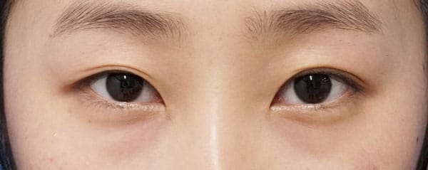 二重埋没法抜糸＋二重埋没法（3点連結止め）もとびアイゴールド　手術前