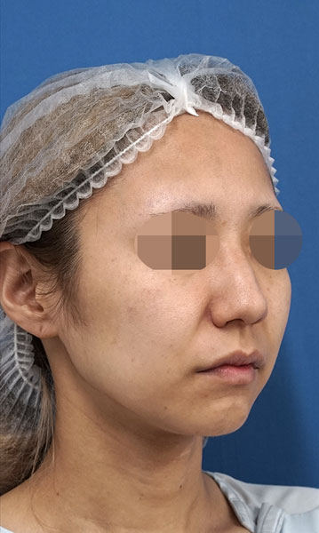 小顔脂肪吸引(ホホ・アゴ下・ほうれい線上) 術前 右斜め