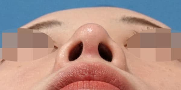 鼻尖縮小・軟骨移植・ストラット　６ヶ月後　下から