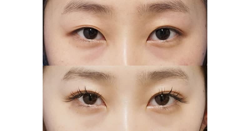 取れかけた二重埋没法を抜糸してしっかり再埋没しました｜もとびアイゴールド（二重3点連結止め）　4か月後