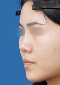 鼻ボラックス 術後1週間 斜め