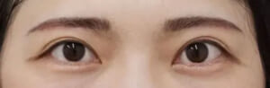 眉近い人術後