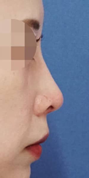 鼻尖縮小・軟骨移植・ストラット　６か月後　右側面のAfterの写真