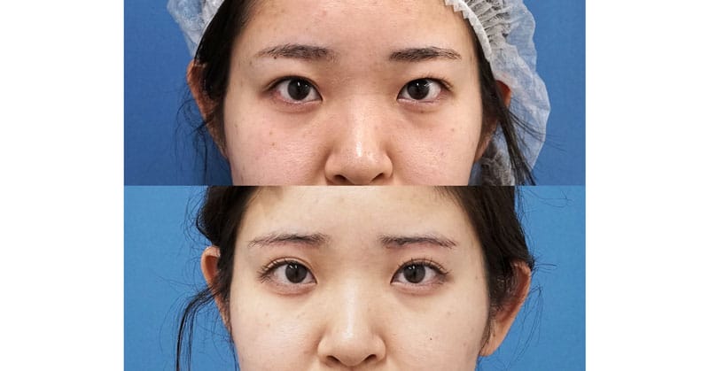 二重全切開を考えていた人に眉下切開｜眉下切開　１週間後（抜糸直後）、１ヶ月後