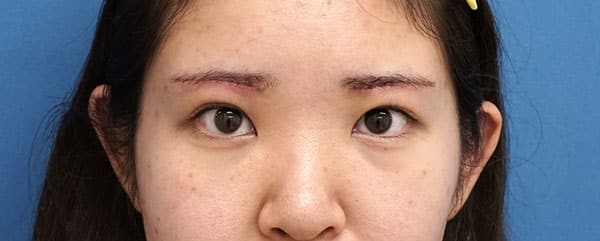 眉下切開　１週間後（抜糸直後）のAfterの写真