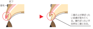 二重部分でたるみ取った場合