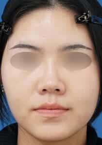 鼻ボラックス 術後1週間 正面